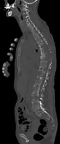 Scanner sagittal reconstruit, représentation dans la fenêtre osseuse. Comme la patiente avait des métastases dans toutes les régions du corps, elle ne pouvait pas lever les bras pour l'examen, ce pourquoi les mains sont présentées.