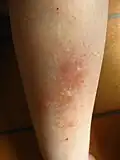 Récidive de lichen simplex chronique sur le tibia