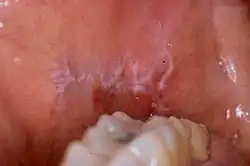 Lichen plan buccal, face interne de la joue, en fond de bouche.