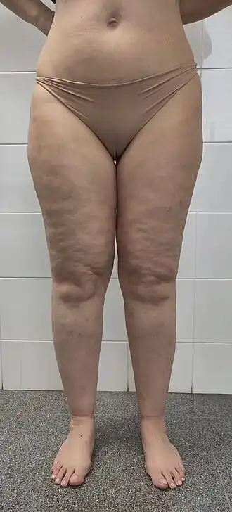 Description de l'image Lipedema, type III.jpg.