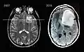 Scanner IRM d'un patient atteint d'un astrocytome montrant l'évolution sur 7 ans.