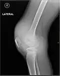 Radiographie montrant les complications liées à l'hémarthrose.