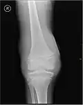Radiographie montrant un début d'hémarthrose.