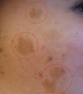 Description de l'image Melasmablemish.jpg.