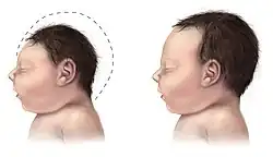  dessin montrant le profil de la tête de 2 nouveau-nés l'un ayant un petit crâne microcéphale et l'autre normal