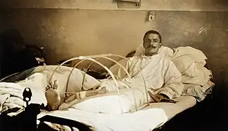 Soldat blessé à Verdun et amputé de la jambe à l'hôpital militaire de Ris-Orangis. 1916.