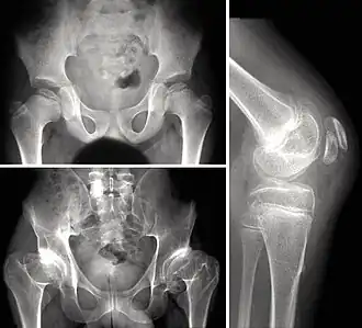 Description de l'image Multipel epifyseal dysplasi skelett.jpg.