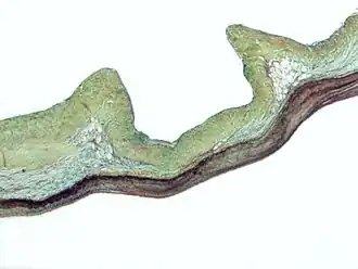 Description de l'image Myxomatous aortic valve.jpg.