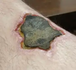 Nécrose causée par la morsure d'une Loxosceles reclusa.