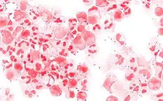 N. meningitidis et PNN dans un LCR infecté (méningite)