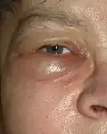 Œdème péri-orbital.