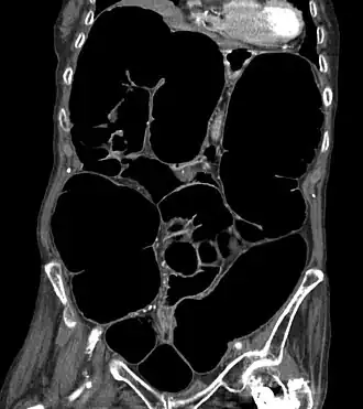 Description de l'image Ogilvie ct coronal.jpg.