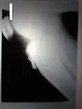 Radiographie d'un Osgood-Schlatter