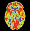 Scan par TEP d'un cerveau en bonne santé.