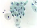 Cellule atrophique sur un frottis d'une femme ménopausée.
