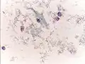 Cellule avec nombreuses bactéries de la flore de Doderlein.