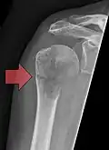 Fracture pathologique de l'humérus sur une métastase de carcinome du rein