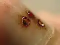 Ongle du pouce de pied à la suite du perçage