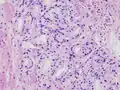 Adénocarcinome prostatique