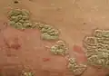 Plaques de psoriasis.