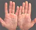 Psoriasis en plaque sur la paume des mains.