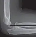Radiographie de l'articulation huméro-radiale normale avec l'axe du radius aligné avec le capitulum.