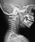 Un abcès rétropharyngien