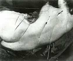 Photo noir et blanc, mal définie, montrant plusieurs déchirures profondes au niveau du dos du personnage.