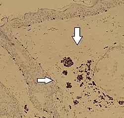 Immunohistochimie SOX10 dans un nævus dermique, montrant des cellules de nævus à coloration positive (flèches)