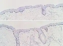Immunohistochimie SOX10 de la peau normale (en haut) et de la prolifération mélanocytaire atypique (en bas), observée principalement dans les follicules pileux.