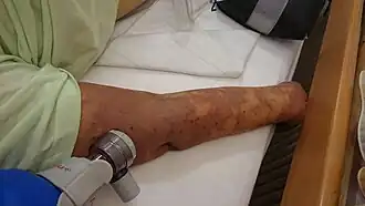 Description de l'image Sepsis-Mikrothomben3.JPG.