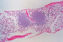 Sur un étalement de moelle osseuse on observe deux volumineuse concentration de lymphocytes en amas