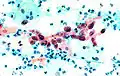 Cellule d'un cancer épidermoïde dans un frottis.