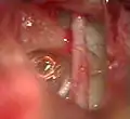 Platinotomie laser