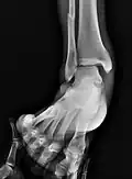 Vue AP en contrainte manuelle montrant une déchirure du ligament deltoïde.