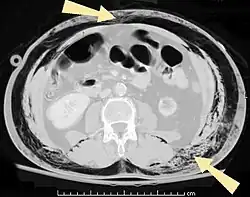 Image illustrative de l’article Emphysème sous-cutané