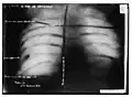 Radiographie de la balle de Schrank dans la poitrine de Roosevelt.