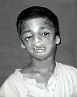 Image d'un enfant atteint du syndrome de Treacher Collins vu de face, montrant un déformation du visage au niveau des oreilles, des yeux, des joues et du menton.