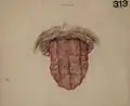 syphilis tertiaire