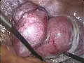 Extraction vaginale de l'utérus lors d'une hystérectomie laparoscopique totale.