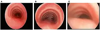 Description de l'image Tracheomalacia.jpg.