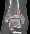 Une fracture triplane de la cheville vue par TDM