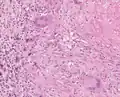 Granulome tuberculoïde avec nécrose caséeuse (En haut à droite)