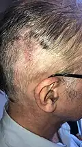 Plaie au niveau pariétal postérieur au jour 15, points de suture enlevés.