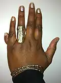 Polydactylie.