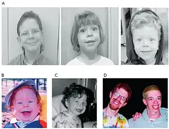 Description de l'image Williams syndromeCCBY.jpg.