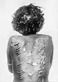 Scarifications sur le dos d'une femme Larrakia