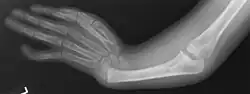 Radiographie AP du membre supérieur montrant un radius absent avec une main déviée radialement