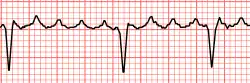 Image illustrative de l’article Flutter atrial